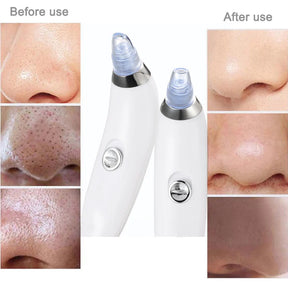 Derma Suction Vacuum Blackhead Remover Pore Cleaner- Skin Care Tool